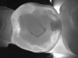Riduzione dosaggio delle radiazioni